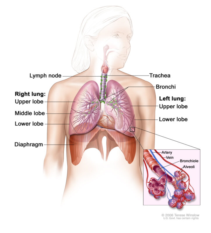 มะเร็งปอดชนิดไม่ใช่เซลล์ขนาดเล็ก (Non-small cell lung cancer – NSCLC)