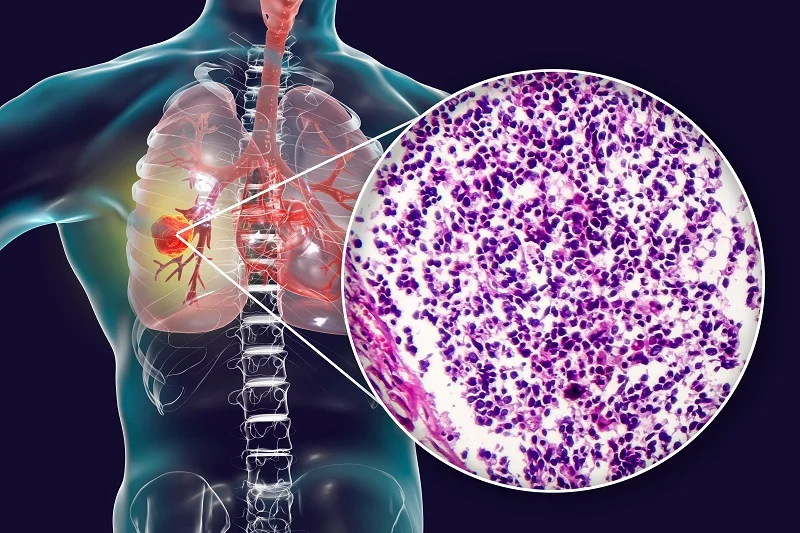 มะเร็งปอดชนิดเซลล์ขนาดเล็ก (Small cell lung cancer – SCLC)