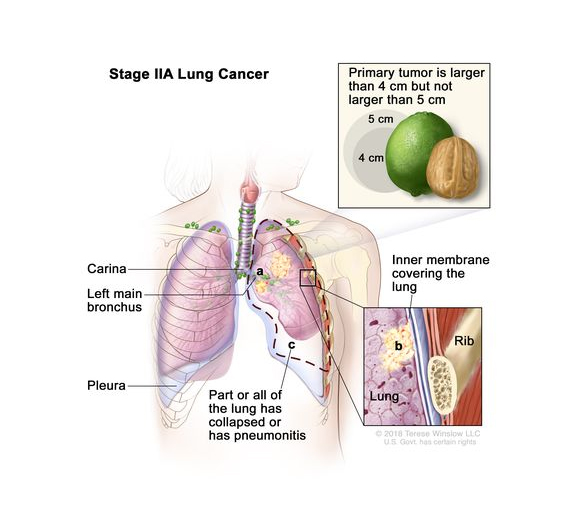มะเร็งปอดระยะ IIA lung cancer (1)