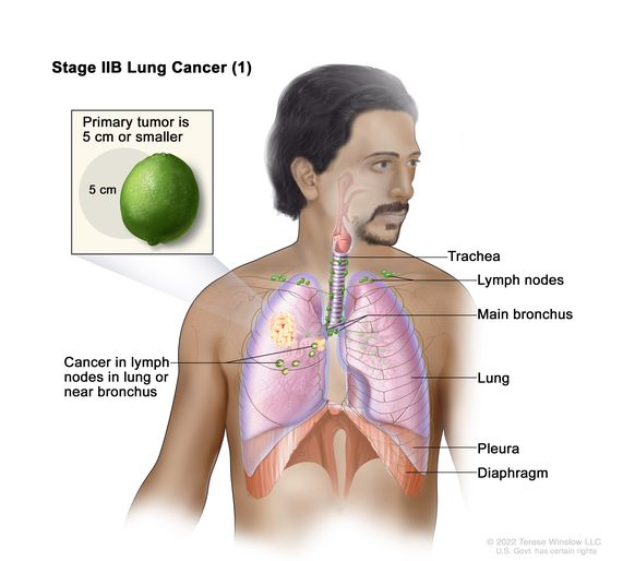 มะเร็งปอดระยะ IIB lung cancer (1)