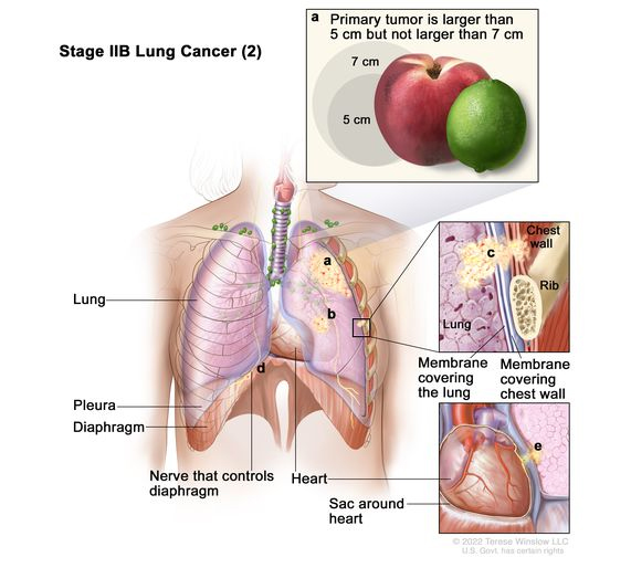 มะเร็งปอดระยะ IIB lung cancer (2)
