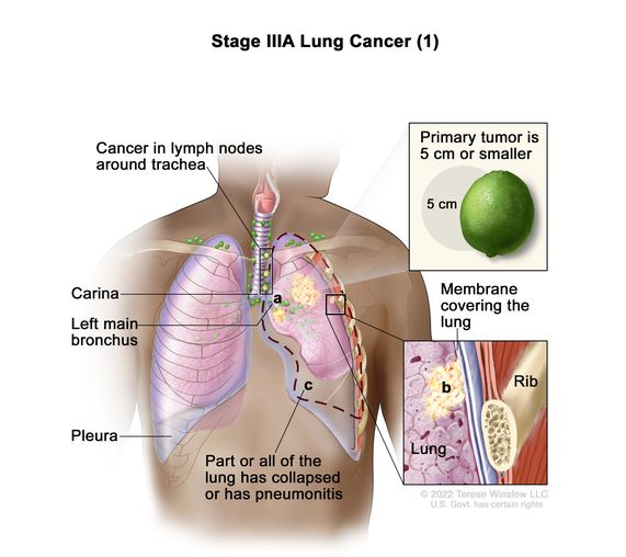 มะเร็งปอดระยะ IIIA lung cancer (1)