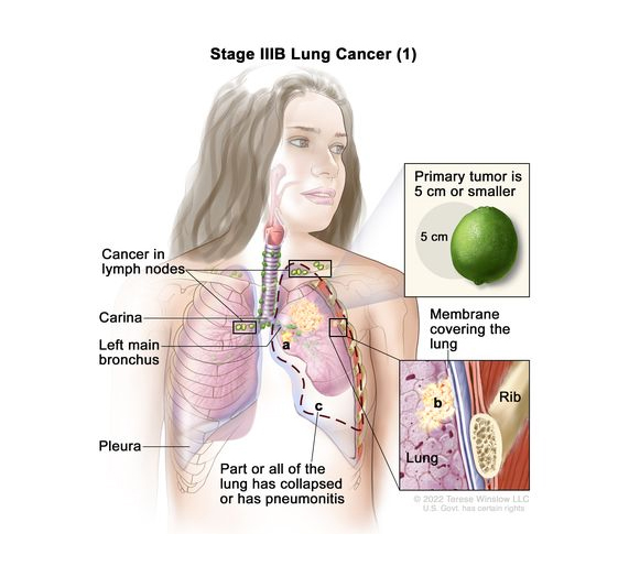 มะเร็งปอดระยะ IIIB lung cancer (1)