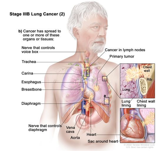 มะเร็งปอดระยะ IIIB lung cancer (2)